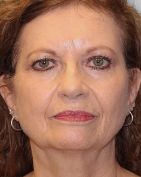 Before Image: Facelift – Dr. Tucker - front