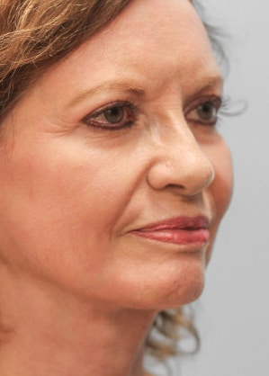 After Image: Facelift – Dr. Tucker -