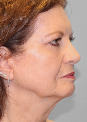 Before Image: Facelift – Dr. Tucker -