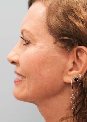 After Image: Facelift – Dr. Tucker - left-side