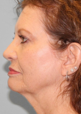 Before Image: Facelift – Dr. Tucker - left-side