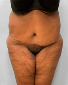 After Image: Body Lift-Dr.Howell