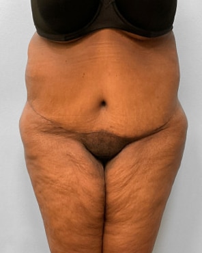 After Image: Body Lift-Dr.Howell - front
