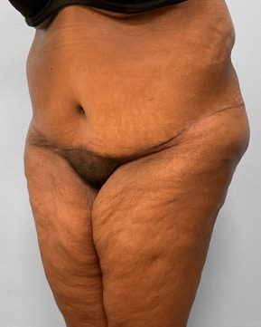 After Image: Body Lift-Dr.Howell - left-front-oblique