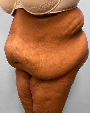 Before Image: Body Lift-Dr.Howell - left-front-oblique
