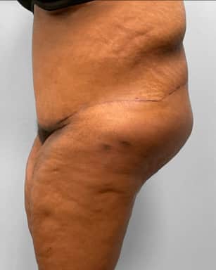 After Image: Body Lift-Dr.Howell - left-side
