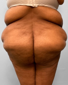 Before Image: Body Lift-Dr.Howell - back