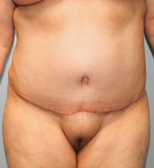 After Image: Breast Reduction, Tummy Tuck & Lipo- Dr.Howell - front