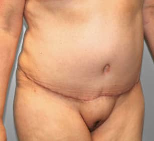 After Image: Breast Reduction, Tummy Tuck & Lipo- Dr.Howell - right-front-oblique