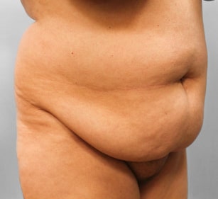 Before Image: Breast Reduction, Tummy Tuck & Lipo- Dr.Howell - right-front-oblique