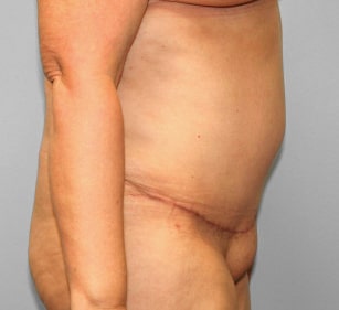 After Image: Breast Reduction, Tummy Tuck & Lipo- Dr.Howell - right-side