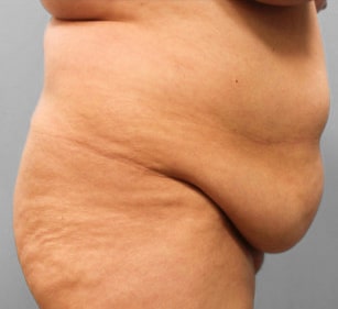 Before Image: Breast Reduction, Tummy Tuck & Lipo- Dr.Howell - right-side