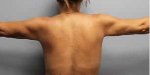 After Image: Arm Lift-Dr.Howell - back