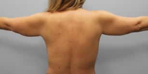 Before Image: Arm Lift-Dr.Howell - back