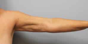 After Image: Arm Lift-Dr.Howell - left-side