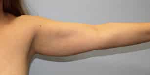 Before Image: Arm Lift-Dr.Howell - left-side