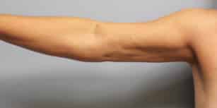 After Image: Arm Lift-Dr.Howell - right-side