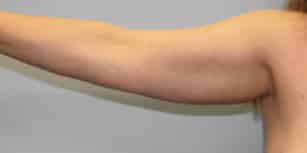 Before Image: Arm Lift-Dr.Howell - right-side