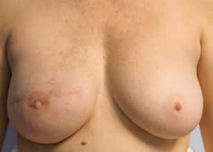 After Image: Breast Reconstruction-Dr.Tucker - front