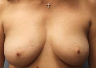 Before Image: Breast Reconstruction-Dr.Tucker - front