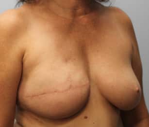 After Image: Breast Reconstruction-Dr.Tucker - right-front-oblique