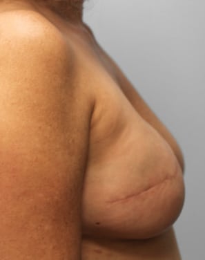 After Image: Breast Reconstruction-Dr.Tucker - right-side