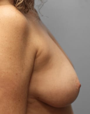 Before Image: Breast Reconstruction-Dr.Tucker - right-side