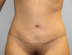 After Image: Abdominoplasty & Lipo- Dr. Howell - front
