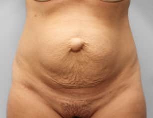 Before Image: Abdominoplasty & Lipo- Dr. Howell - front
