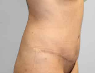 After Image: Abdominoplasty & Lipo- Dr. Howell - right-front-oblique