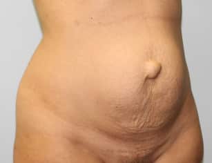 Before Image: Abdominoplasty & Lipo- Dr. Howell - right-front-oblique