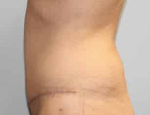 After Image: Abdominoplasty & Lipo- Dr. Howell - left-side