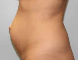 Before Image: Abdominoplasty & Lipo- Dr. Howell - left-side
