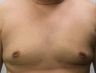 After Image: Gynecomastia-Dr. Howell - front