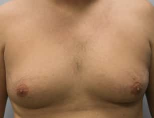Before Image: Gynecomastia-Dr. Howell - front