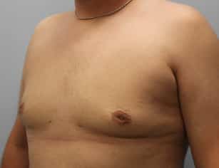 After Image: Gynecomastia-Dr. Howell - left-front-oblique