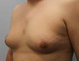Before Image: Gynecomastia-Dr. Howell - left-front-oblique