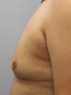 After Image: Gynecomastia-Dr. Howell - left-side