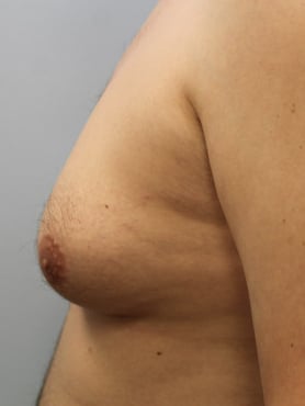 Before Image: Gynecomastia-Dr. Howell - left-side