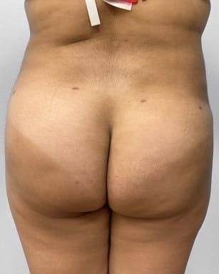 After Image: Liposuction & BBL Injections- Dr. Howell - back