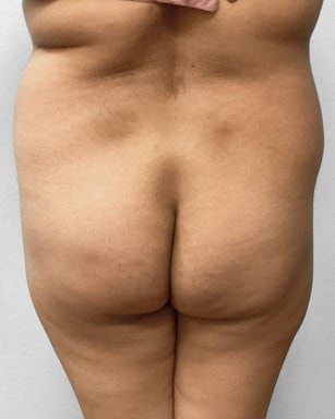 Before Image: Liposuction & BBL Injections- Dr. Howell - back