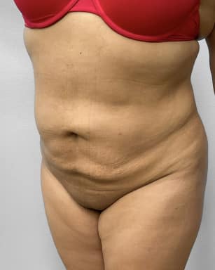 After Image: Liposuction & BBL Injections- Dr. Howell - left-front-oblique