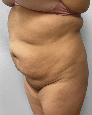 Before Image: Liposuction & BBL Injections- Dr. Howell - left-front-oblique