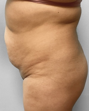 Before Image: Liposuction & BBL Injections- Dr. Howell - left-side