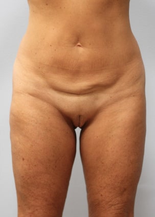 Before Image: Body Lift & SmartLipo- Dr. Howell - front