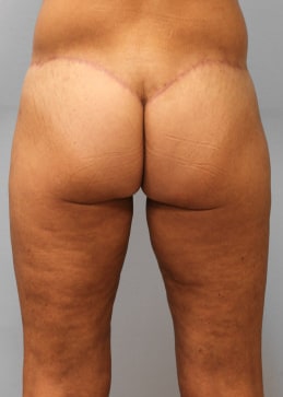 After Image: Body Lift & SmartLipo- Dr. Howell - back