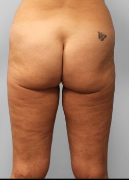 Before Image: Body Lift & SmartLipo- Dr. Howell - back