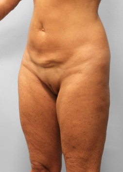 Before Image: Body Lift & SmartLipo- Dr. Howell - left-front-oblique