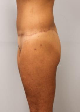 After Image: Body Lift & SmartLipo- Dr. Howell - left-side