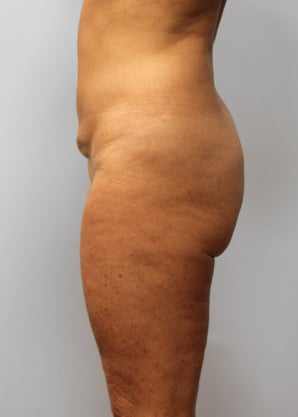 Before Image: Body Lift & SmartLipo- Dr. Howell - left-side